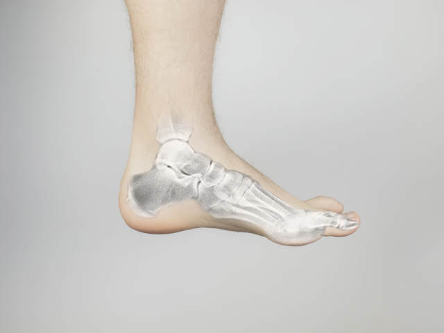 Fractures et autres urgences du pied à Gatineau, Hull, Aylmer