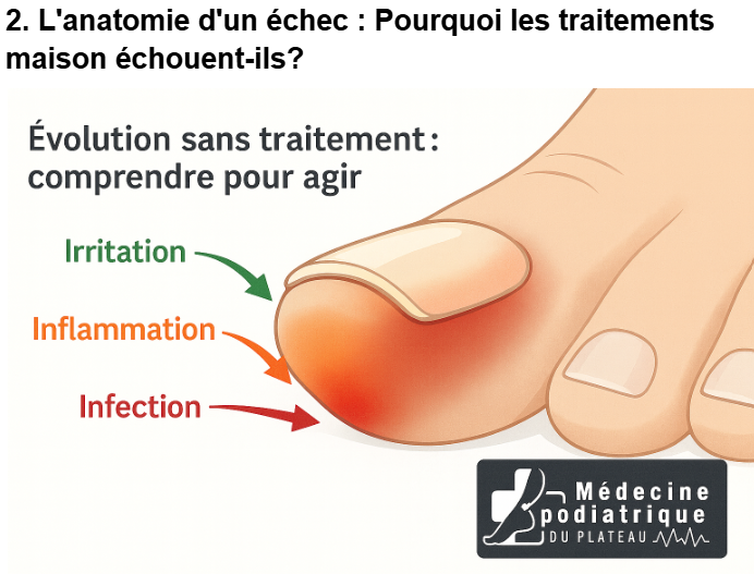 combien de temps guérir ongle incarné"