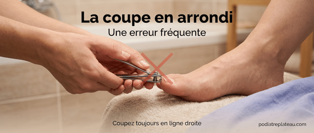 matricectomie-ongle-incarné