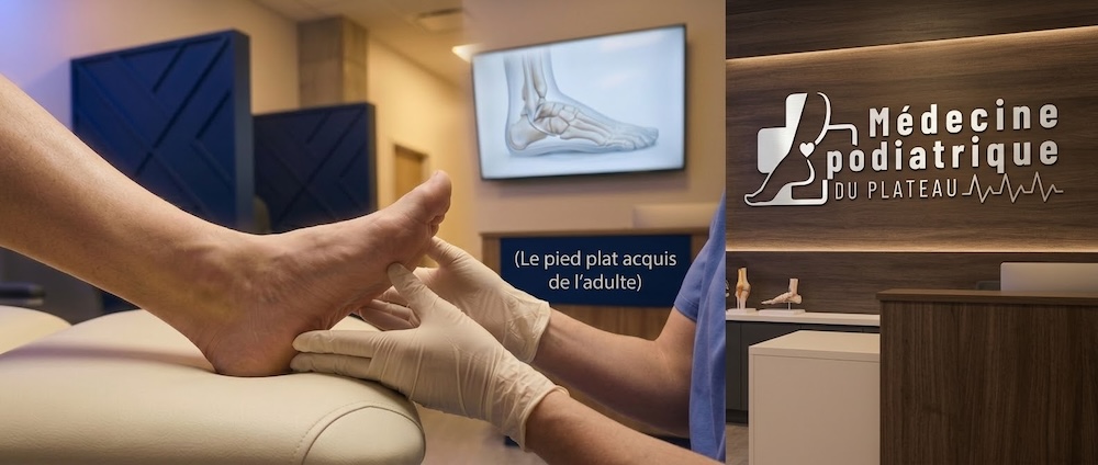Illustration anatomique du tendon tibial postérieur et de la voûte plantaire, affaissement progressif dans le pied plat acquis de l'adulte (PCFD)